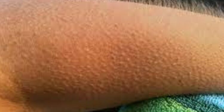 goosebumps-meaning