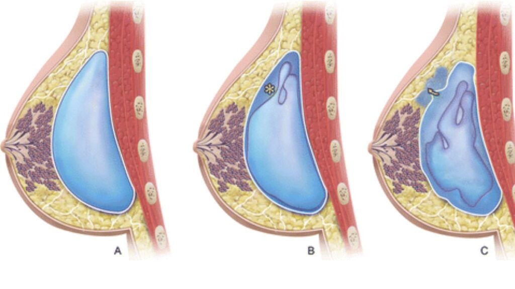 Ann Arbor Plastic Surgery - What are the Benefits of Gummy Bear Implants? Gummy  bear breast implants are frequently manufactured in a teardrop shape, which  is intended to more closely imitate a