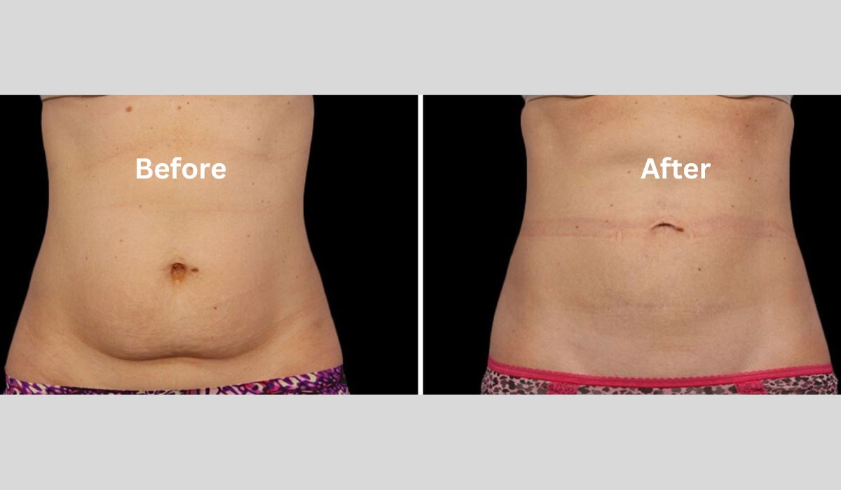 CoolSculpting Before and After: Achieving Your Desired Body Shape