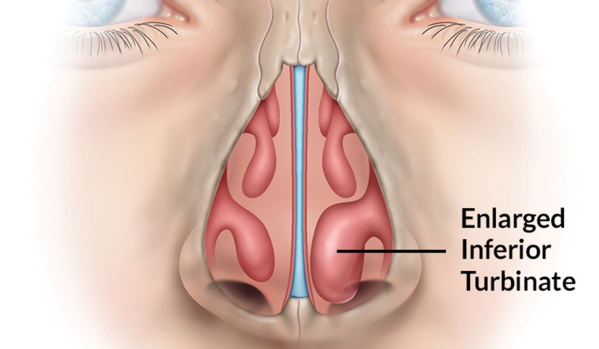 Turbinoplasty: A Breath of Fresh Air