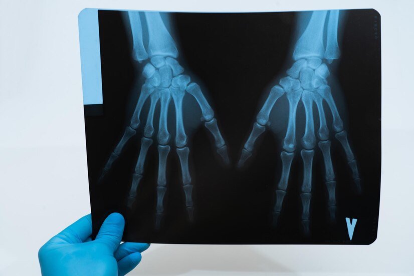 Psoriatic Arthritis Radiology