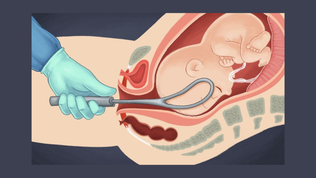 Forceps