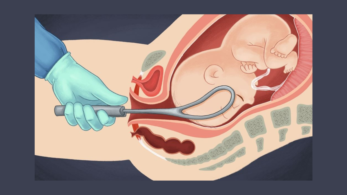 Forceps