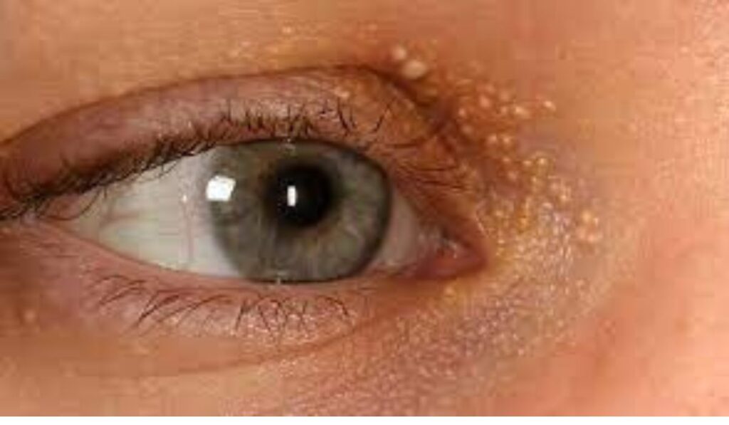 Say Goodbye to Milia: Effective Remedies for Clear Skin