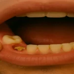 Food Stuck in Wisdom Tooth Hole