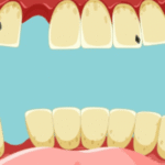 Tooth Gap: Understanding the Space Between Smiles