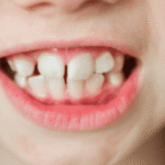 teeth gap