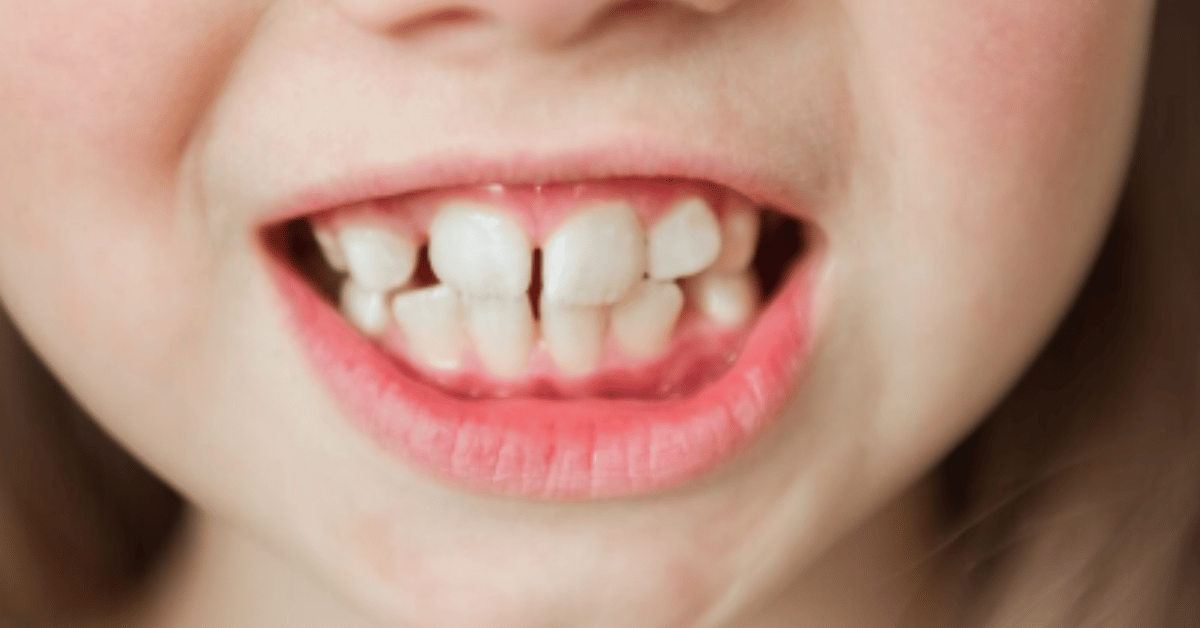 teeth gap