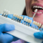 ceramic teeth cap