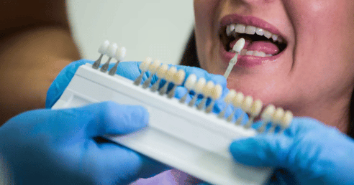 ceramic teeth cap