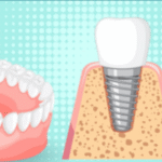 screw in teeth