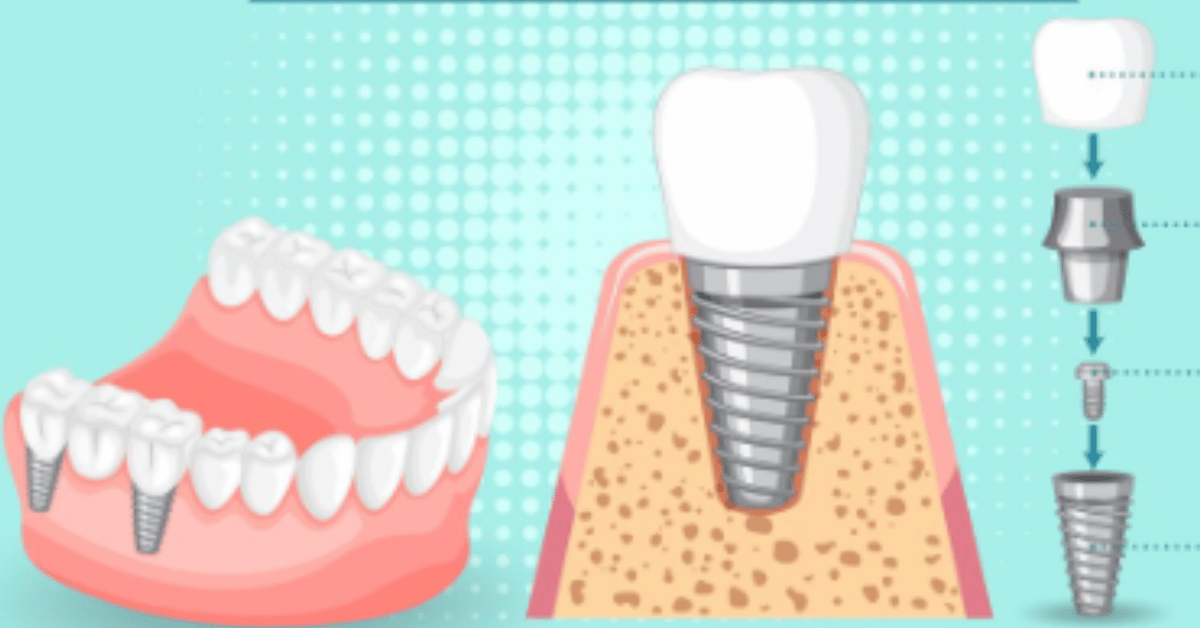 screw in teeth