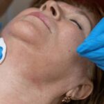 milia removal