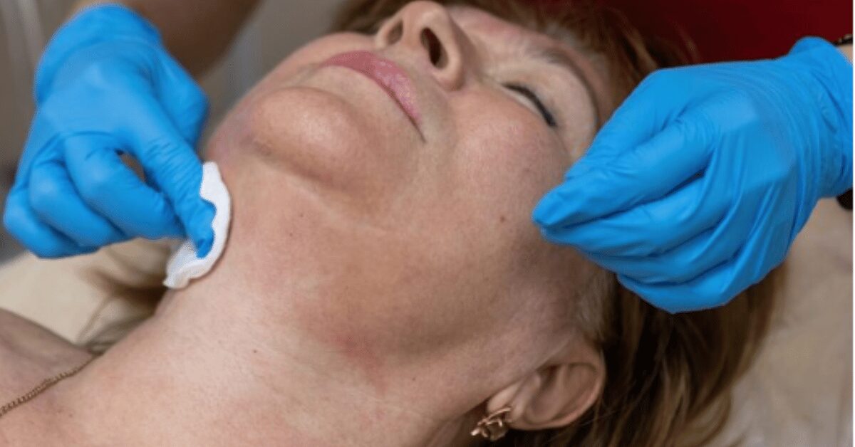 milia removal
