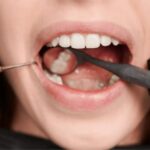 gum graft