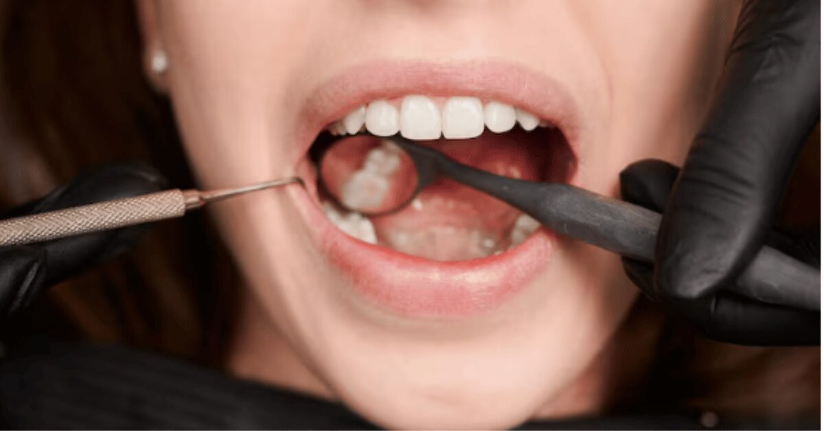 gum graft