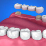 Cantilever Bridge Dental